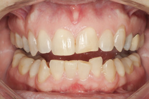 Accreditation Case Type 2 Pre-op, Matching Existing Dentition
