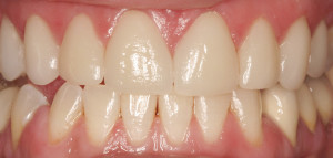 K Post-op Empress Crowns ##5, 12, Empress Veneers ##6, 7, 8, 9, 10, 11