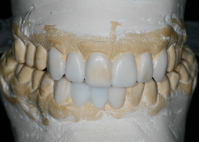 Diagnostic Wax Up colorado dental lab